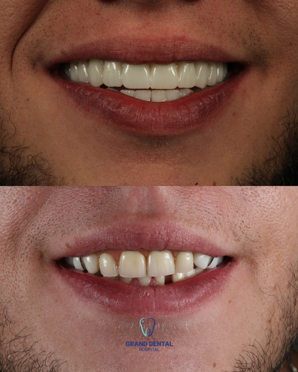 نتائج قبل وبعد تركيب تيجان الزركونيا في Grand Dental Hospital & Laboratory، تجميل الابتسامة
