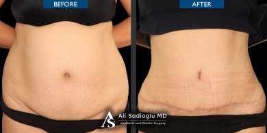 Результати до і після абдомінопластики та ліпосакції в клініці Dr. Safa Manav, плоский живіт
