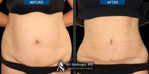 Результати до і після абдомінопластики та ліпосакції в клініці Dr. Safa Manav, плоский живіт