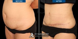 Результати до і після абдомінопластики та ліпосакції в клініці Dr. Safa Manav, плоский живіт
