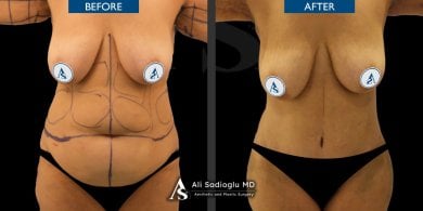 Vorher-nachher-Ergebnisse Bauchdeckenstraffung und Fettabsaugung Dr. Safa Manav Clinic, schlankere Taille