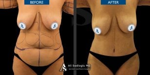 Vorher-nachher-Ergebnisse Bauchdeckenstraffung und Fettabsaugung Dr. Safa Manav Clinic, schlankere Taille