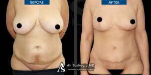 Результати до і після абдомінопластики та ліпосакції в клініці Dr. Safa Manav, плоский живіт