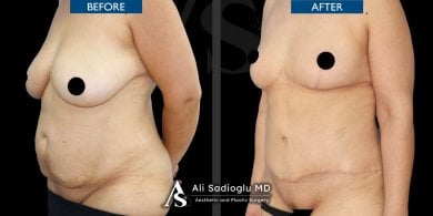 Vorher-nachher-Ergebnis Bauchdeckenstraffung und Fettabsaugung bei Dr. Safa Manav Clinic