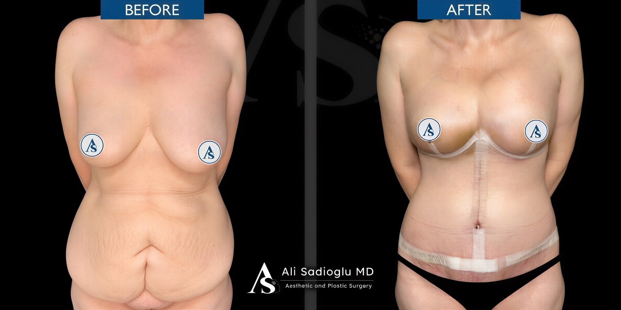 Resultados antes y después de abdominoplastia y liposucción en Dr. Safa Manav Clinic