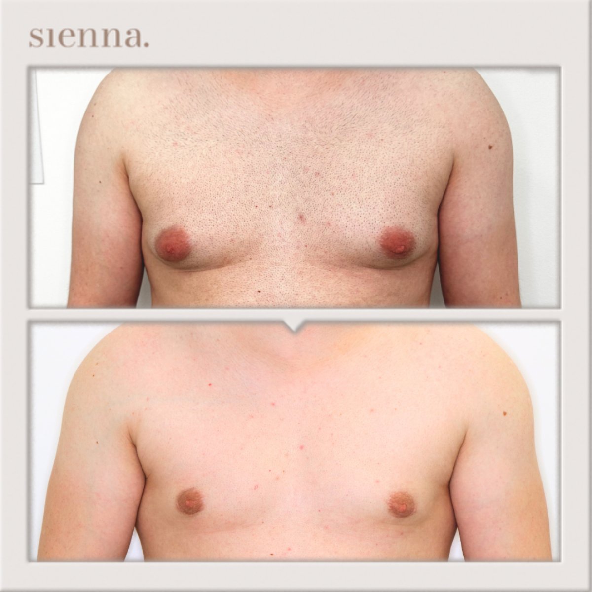 نتائج قبل وبعد جراحة التثدي في Sienna Clinic – تحسين شكل صدر الرجل