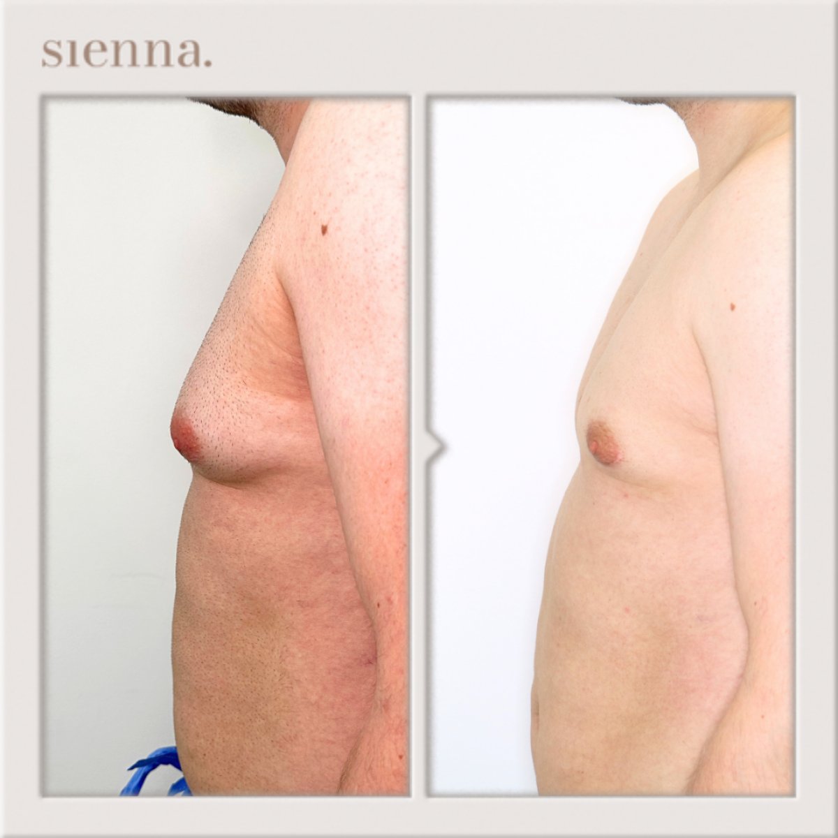 نتائج قبل وبعد جراحة التثدي في Sienna Clinic – تحسين شكل صدر الرجل