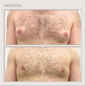 نتائج قبل وبعد جراحة التثدي في Sienna Clinic، تحسين شكل الصدر للرجال
