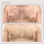 نتائج قبل وبعد جراحة التثدي في Sienna Clinic، تحسين شكل الصدر للرجال