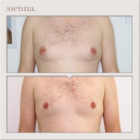 نتائج قبل وبعد جراحة التثدي في Sienna Clinic، تحسين شكل صدر الرجل