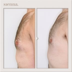 نتائج قبل وبعد جراحة التثدي في عيادة سيينا – تحسين شكل صدر الرجل