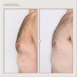 نتائج قبل وبعد جراحة التثدي في عيادة سيينا – تحسين شكل صدر الرجل