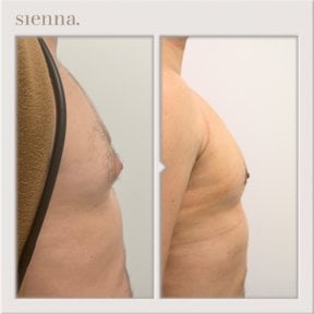 نتائج قبل وبعد جراحة التثدي في Sienna Clinic، تحسين شكل صدر الرجل