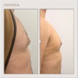 نتائج قبل وبعد جراحة التثدي في Sienna Clinic، تحسين شكل صدر الرجل