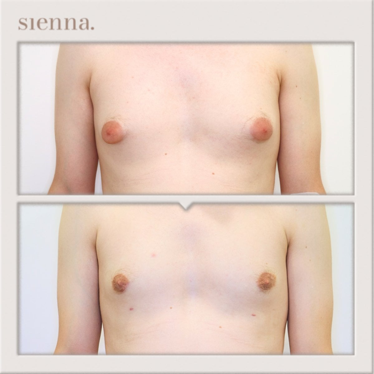 نتائج قبل وبعد جراحة التثدي في Sienna Clinic – تحسين شكل صدر الرجل