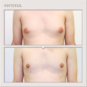 Before and after gynecomastia surgery results at Sienna Clinic – male chest contour improvement