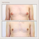 Before and after gynecomastia surgery results at Sienna Clinic – male chest contour improvement