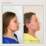 Before and after neck lift results at Sienna Clinic – improved jawline and neck contour