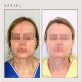 Before and after facelift results at Sienna Clinic, visible facial rejuvenation and lifting