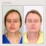 Before and after facelift results at Sienna Clinic, visible facial rejuvenation and lifting