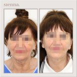 Before and after facelift results at Sienna Clinic, visible facial rejuvenation and tightening
