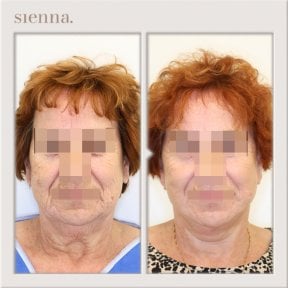 Before and after facelift results at Sienna Clinic, visible facial rejuvenation and skin tightening