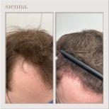 Before and after hair transplant result at Sienna Clinic, restored hairline and fuller hair