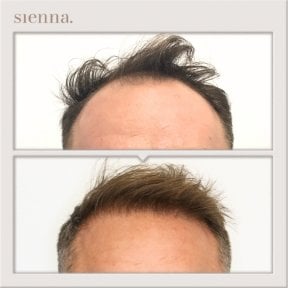 Résultats avant et après greffe de cheveux à la Sienna Clinic, ligne capillaire restaurée