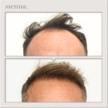 Résultats avant et après greffe de cheveux à la Sienna Clinic, ligne capillaire restaurée