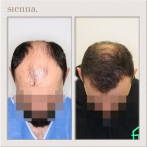Avant-après greffe de cheveux à Sienna Clinic – ligne capillaire et densité restaurées