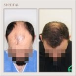 Avant-après greffe de cheveux à Sienna Clinic – ligne capillaire et densité restaurées