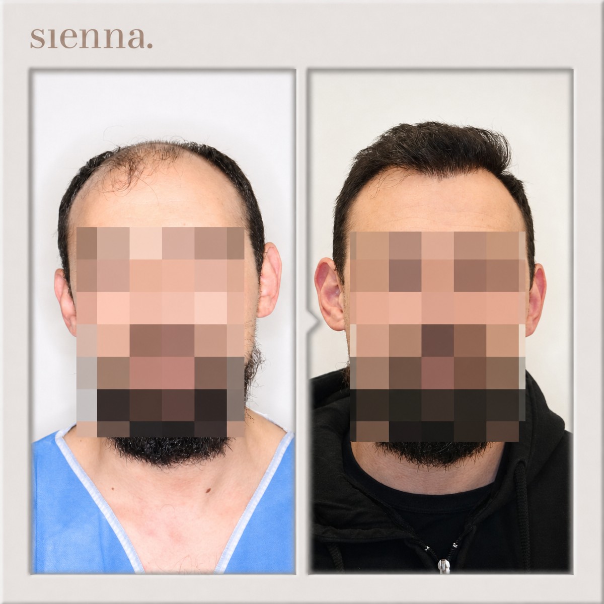 Resultados de trasplante capilar antes y después en Sienna Clinic, línea capilar restaurada
