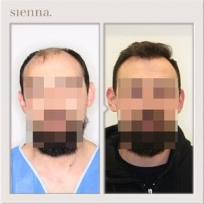 Résultats avant et après greffe de cheveux à Sienna Clinic, ligne capillaire restaurée
