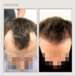 Before and after hair transplant at Sienna Clinic, restored hairline and fuller hair result
