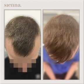 Before and after hair transplant results at Sienna Clinic, improved hair density and coverage