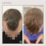 Before and after hair transplant results at Sienna Clinic, improved hair density and coverage