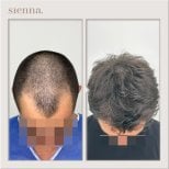 Before and after hair transplant result at Sienna Clinic – restored hairline and fuller hair