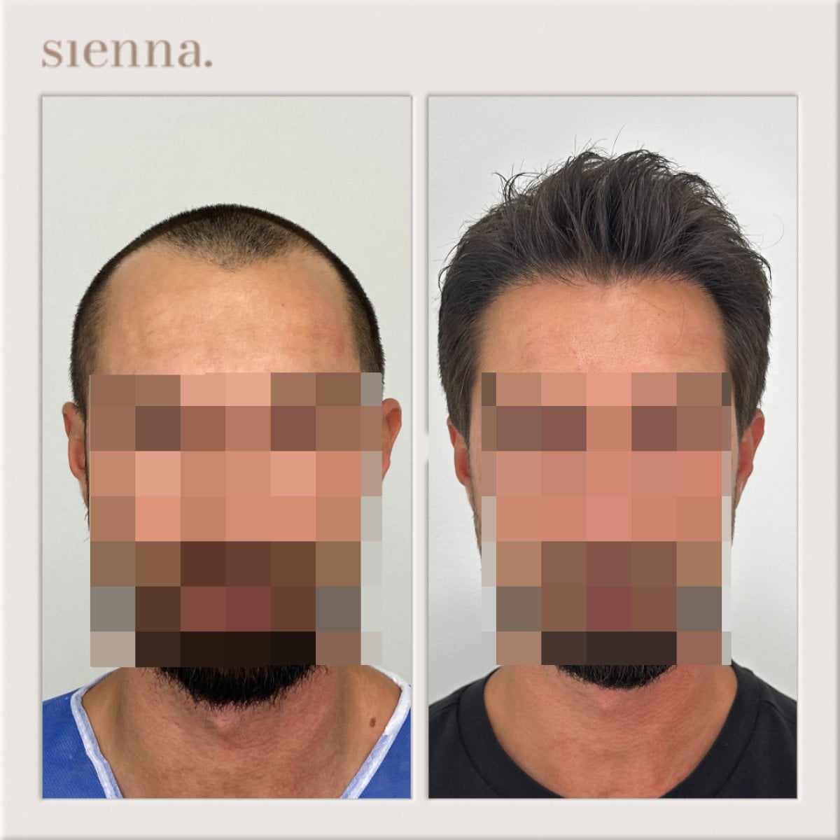 نتائج زراعة الشعر قبل وبعد في Sienna Clinic، استعادة خط الشعر الطبيعي