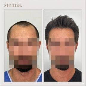 Résultats avant/après greffe de cheveux à Sienna Clinic, ligne capillaire restaurée
