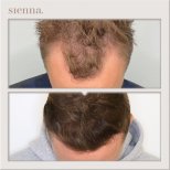 نتائج زراعة الشعر قبل وبعد في Sienna Clinic – استعادة خط الشعر وكثافة أكبر