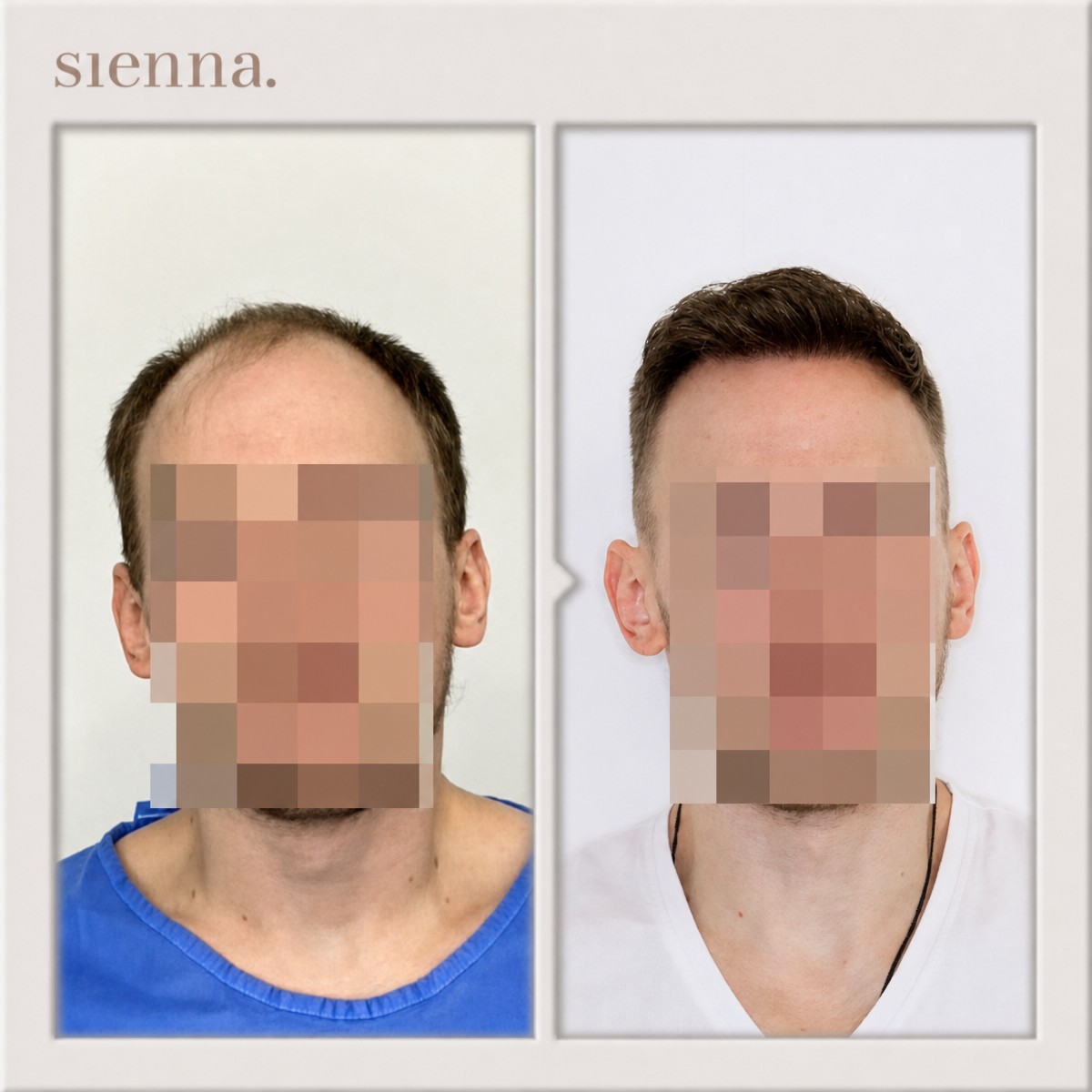 Resultado de trasplante capilar antes y después en Sienna Clinic, línea capilar restaurada