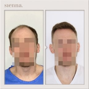 Before and after hair transplant result at Sienna Clinic, restored hairline in male patient