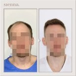 Before and after hair transplant result at Sienna Clinic, restored hairline in male patient