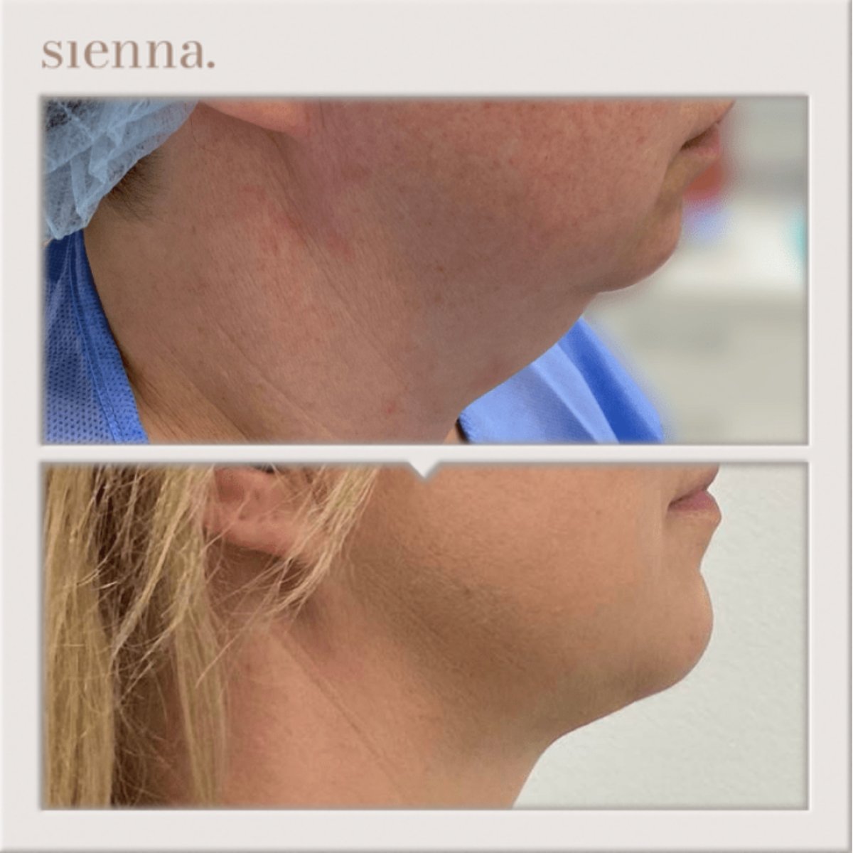 Antes y después de liposucción de mentón en Sienna Clinic – contorno visible de la mandíbula