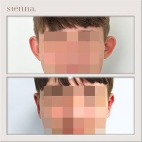 Before and after otoplasty results at Sienna Clinic, ear reshaping with natural appearance