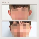Before and after otoplasty results at Sienna Clinic, ear reshaping with natural appearance