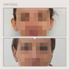 Before and after otoplasty results at Sienna Clinic, ear reshaping with natural appearance