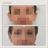 Before and after otoplasty results at Sienna Clinic, ear reshaping with natural appearance