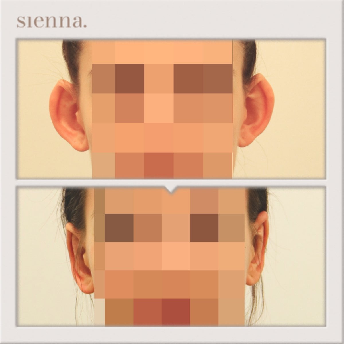 نتائج تجميل الأذن قبل وبعد في Sienna Clinic، إعادة تشكيل الأذن بمظهر طبيعي