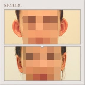 Before and after otoplasty results at Sienna Clinic, ear reshaping with natural appearance